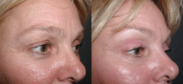 Brow Lift Before and After | New Albany IN, St. Matthews KY