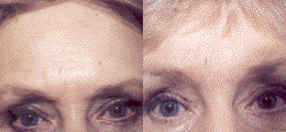 Brow Lift Before and After | New Albany IN, St. Matthews KY