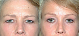 Brow Lift Gallery