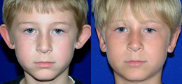 Ear Reshaping Before and After | New Albany IN, St. Matthews KY
