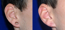 Earlobe Gauge Repair Gallery