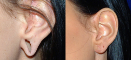 Ear Reshaping Before and After | New Albany IN, St. Matthews KY