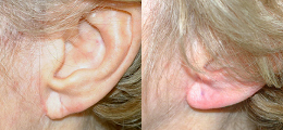 Ear Reshaping Before and After | New Albany IN, St. Matthews KY