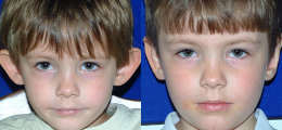Ear Reshaping Before and After | New Albany IN, St. Matthews KY