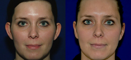 Ear Reshaping Before and After | New Albany IN, St. Matthews KY