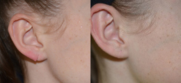 Ear Reshaping Before and After | New Albany IN, St. Matthews KY