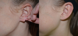 Earlobe Repair Gallery