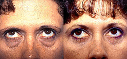 Eyelid Lift Before and After | New Albany IN, St. Matthews KY
