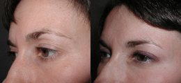 Eyelid Lift Before and After | New Albany IN, St. Matthews KY