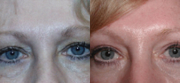 Eyelid Lift Before and After | New Albany IN, St. Matthews KY