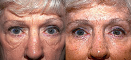 Eyelid Lift Before and After | New Albany IN, St. Matthews KY