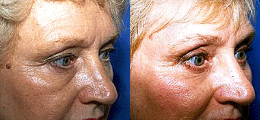 Eyelid Lift Before and After | New Albany IN, St. Matthews KY