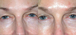 Eyelid Lift Before and After | New Albany IN, St. Matthews KY