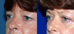 Eyelid Lift Before and After | New Albany IN, St. Matthews KY