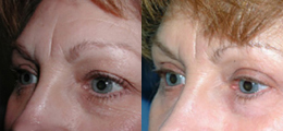 Eyelid Lift Before and After | New Albany IN, St. Matthews KY
