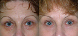 Eyelid Lift Before and After | New Albany IN, St. Matthews KY