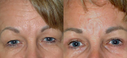 Eyelid Lift Before and After | New Albany IN, St. Matthews KY