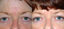 Eyelid Lift Before and After | New Albany IN, St. Matthews KY