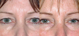 Eyelid Lift Before and After | New Albany IN, St. Matthews KY