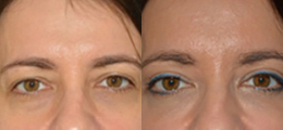 Eyelid Lift Before and After | New Albany IN, St. Matthews KY
