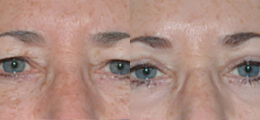 Eyelid Lift Before and After | New Albany IN, St. Matthews KY