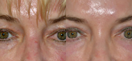 Eyelid Lift Before and After | New Albany IN, St. Matthews KY