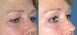 Eyelid Lift Before and After | New Albany IN, St. Matthews KY