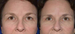 Eyelid Lift Before and After | New Albany IN, St. Matthews KY
