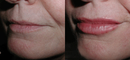 Lip Enhancement Before and After | New Albany IN, St. Matthews KY
