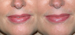 Lip Enhancement Before and After | New Albany IN, St. Matthews KY