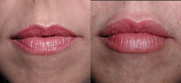 Lip Enhancement Gallery