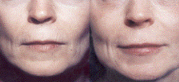 Lip Enhancement Before and After | New Albany IN, St. Matthews KY