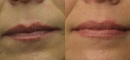 Lip Enhancement Before and After | New Albany IN, St. Matthews KY