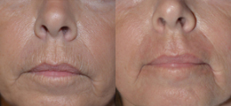 Lip Enhancement Before and After | New Albany IN, St. Matthews KY