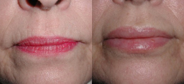Lip Enhancement Before and After | New Albany IN, St. Matthews KY