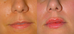 Lip Enhancement Before and After | New Albany IN, St. Matthews KY