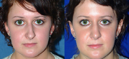 Nose Reshaping Before and After | New Albany IN, St. Matthews KY
