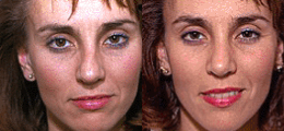 Nose Reshaping Before and After | New Albany IN, St. Matthews KY