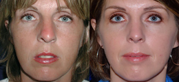 Nose Reshaping Before and After | New Albany IN, St. Matthews KY