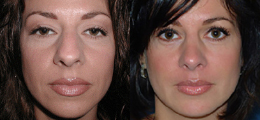 Nose Reshaping Before and After | New Albany IN, St. Matthews KY