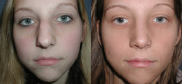Nose Reshaping Before and After | New Albany IN, St. Matthews KY