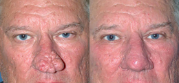 Nose Reshaping Before and After | New Albany IN, St. Matthews KY