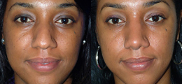 Nose Reshaping Before and After | New Albany IN, St. Matthews KY