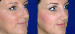 Nose Reshaping Before and After | New Albany IN, St. Matthews KY