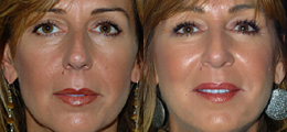 Nose Reshaping Before and After | New Albany IN, St. Matthews KY