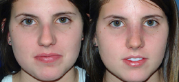 Nose Reshaping Before and After | New Albany IN, St. Matthews KY