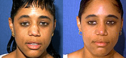 Nose Reshaping Before and After | New Albany IN, St. Matthews KY