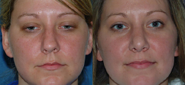 Nose Reshaping Before and After | New Albany IN, St. Matthews KY