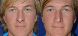 Nose Reshaping Before and After | New Albany IN, St. Matthews KY