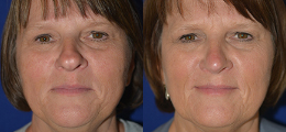 Nose Reshaping Before and After | New Albany IN, St. Matthews KY